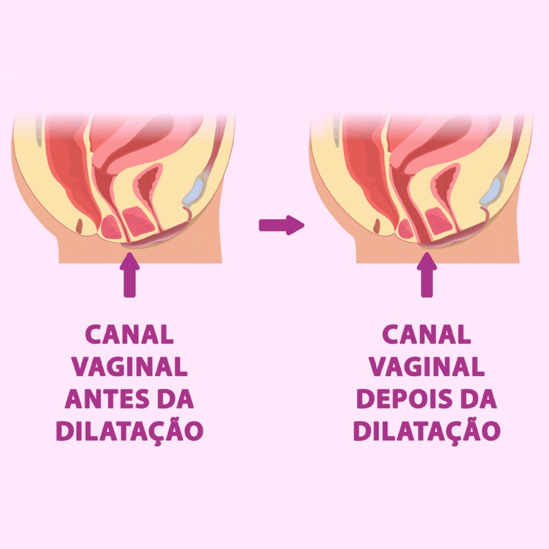 Kit de Dilatador Vaginal Graduados Anelado 6 Unidades Colorido | Foto 04